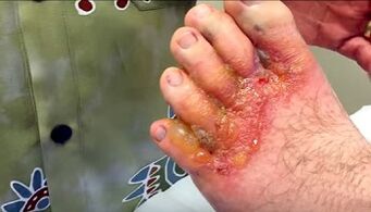 simptomi gljivica na nožnim prstima