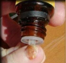 Nanošenje kapi na nokat na nozi zahvaćen gljivicama